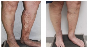 Varicose and spider veins can be safely treated with various procedures ranging such as; EVLA (laser ablation) to special injections.