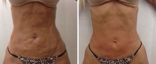 Skin Tightening and Body Contouring, TightSculpting