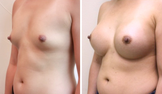 Breast Augmentation, Cosmetic Surgery