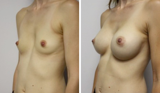 Breast Augmentation, Cosmetic Surgery by Dr. Lee
